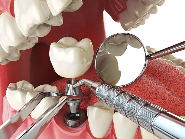 Best Emergency Root Canal Treatment in Walford, IA